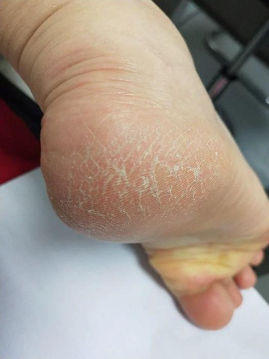 #皮肤干燥#女人脚裂会留下什么痕迹？医生：3点变化一眼看穿，骗不下去