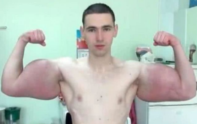 『』那个被叫“大力水手”的俄罗斯男子,往胳膊里注水增肌引起轰动,如今变成怎样