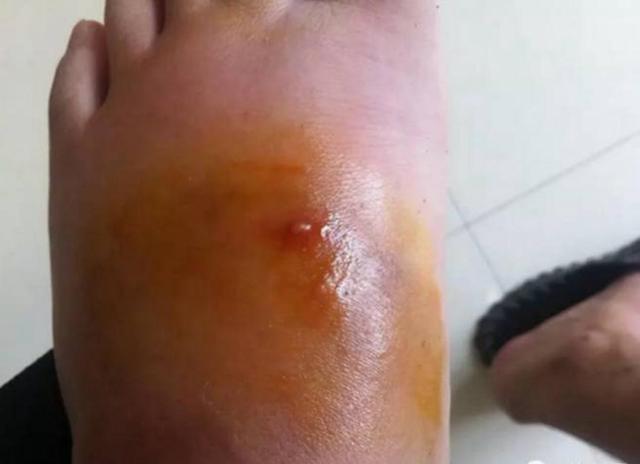 [陕西]要命！凶猛的红火蚁入侵四川，人畜被咬可致休克 村民：太可怕