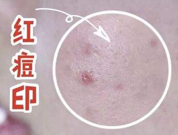 痘痘▲为什么痘印老是消不掉？