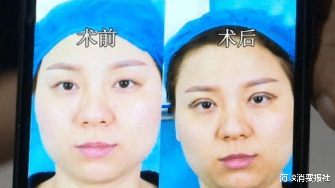 痘痘|女子花7万2割双眼皮，术后眼睛都睁不开，医院：她是装的