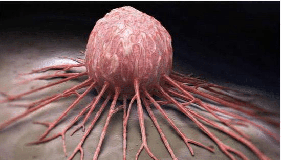 #癌细胞#体内有癌，“腿”先知，“腿部”若有这3异常，可能有癌细胞了！