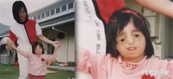 日本女孩天生患有“無臉癥”，5萬人一遇，25歲活成天使模樣-圖2
