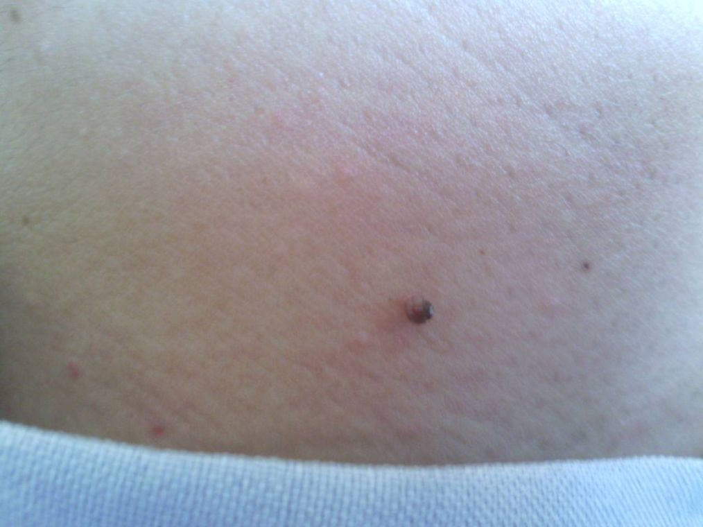 「饮食」脖子上的小肉疙瘩是什么？不仅影响美观，还可能存在这些健康隐患