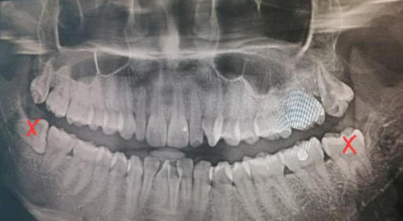 英國15歲妹拔4顆牙上手術臺，19分鐘後竟“嘴咬管子”慘死-圖2