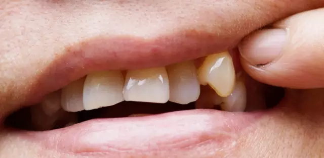 牙齿|掉牙不重视，反惹大麻烦！这么做，上了年纪牙口依然好