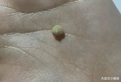 口臭:嘴巴抠出“小米粒”,只是口臭?其实是身体发出的求救信号