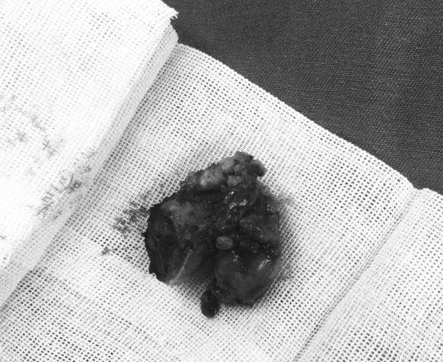 肿瘤|吓人！女子咳嗽吐出“一团肉”，没想到医院一查竟是肿瘤！