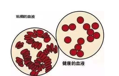 老年病@体内血液粘稠时，身体会出现这4个信号，别等血栓成型了才后悔！