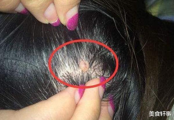 痛风|头皮里的“小疙瘩”是什么?可能已经被这3种病缠上身,无视后悔