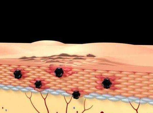 癌细胞：体内癌细胞增多时，皮肤早有信号告知你，可惜很多人都没重视！