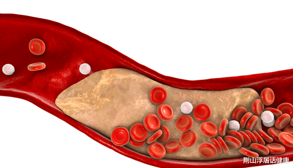 高血脂|高血脂的“祸首”并不是肥肉，这两物每天吃，血液或会“浓如粥”