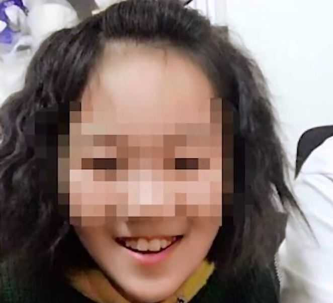 微社评 山西一12岁女孩遭继母虐待，皮肤多处溃烂感染，被虐打成植物人