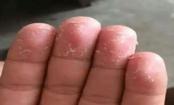 「皮炎」手指“脱皮”,以为是手太干吗,那是身体发出的求救信号!