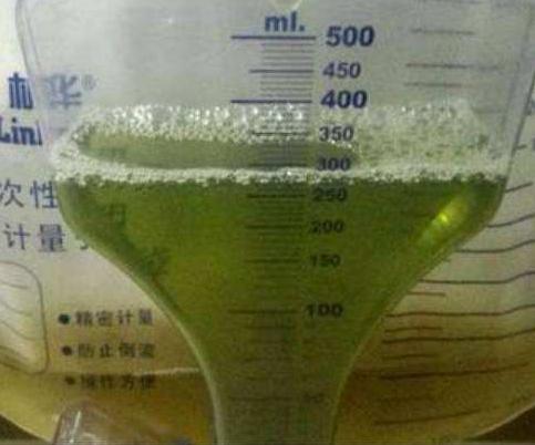 医生▲尿液是肾功能的“试金石”，不同颜色的尿液，究竟意味着什么？