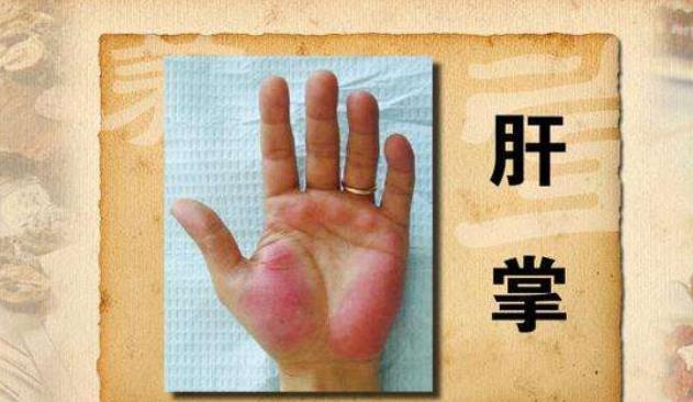 [肝硬化]肝硬化“不痛不痒”？警惕蛛丝马迹，别让肝病种子在你身上发芽