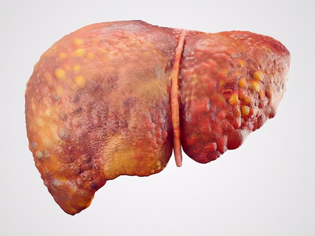 肝癌|56岁男子不沾烟酒，查出肝癌，医生：身上若有\1红2臭\，早检查