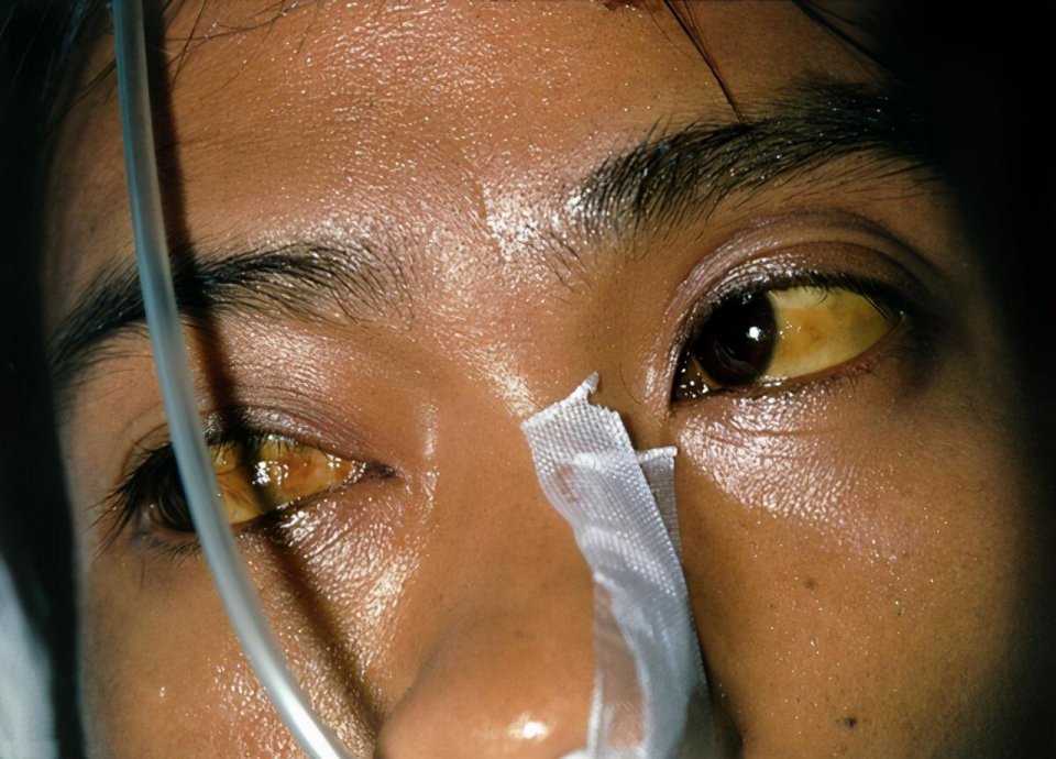 肝脏|肝病是“拖”出来的，医生：早晚各2个症状，是肝发出的求救信号