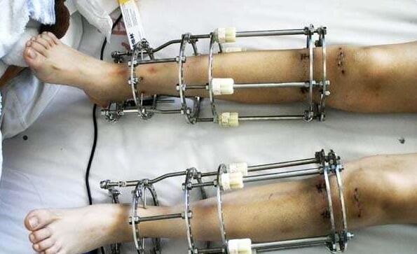 斑马|当年那个花16万锯断骨头，只为长高7厘米的人，现在怎么样了？