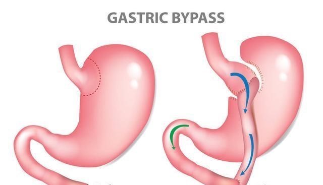 「胃病」胃病越来越年轻化?警告:3物尽早撤下饭桌,胃也许夸你聪明