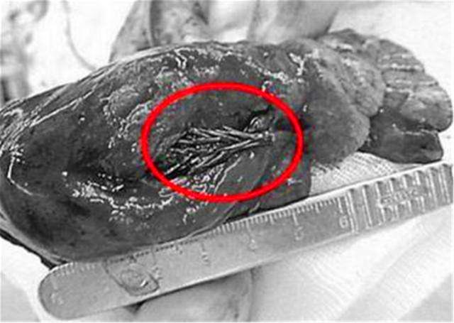 医生@国外男子被确诊为肺癌，手术时，医生在他肺里找到了一棵冷杉树！