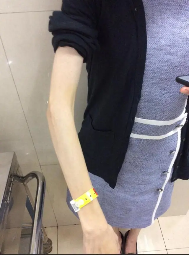 浙样的生活|杭州女孩青春期暴瘦40斤！看到她手指，医生一下明白了