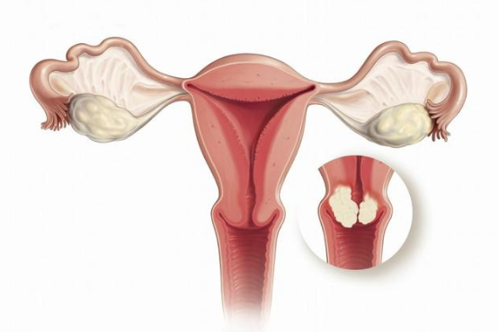 宫颈癌|这4类癌症,即使到了晚期,还是有可能治愈,别太早放弃