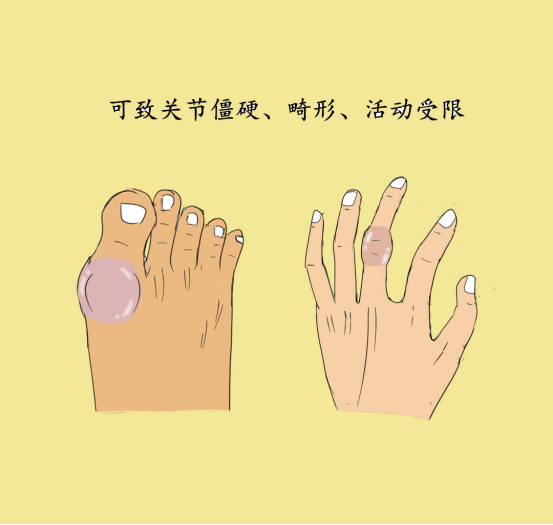 尿酸|年纪轻轻就有痛风，这到底是个啥毛病