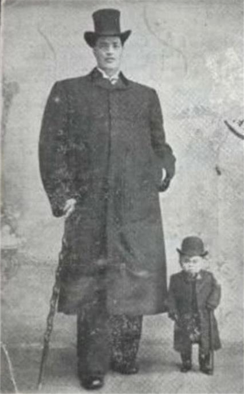 『侏儒症』世界奇人：前半生患上侏儒症，后半生又患上巨人症，世界仅此一人