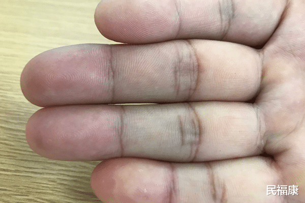 肝脏|肝不好，中指会有所体现，中指若无2种特征，暗示肝脏还不错