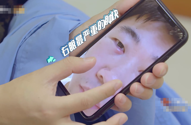 明星|明星压力有多大？杨迪眼睛长肿块，一检查已经老化，亲妈急得流泪！
