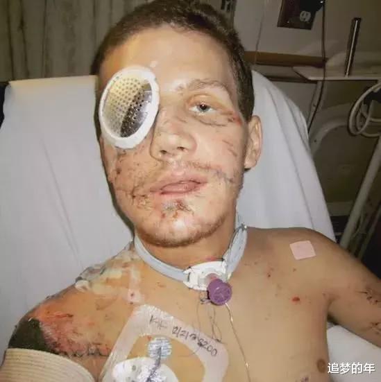 手榴弹：为保护战友扑到手榴弹上, 全身多处撕裂, 他术后的生活让人佩服