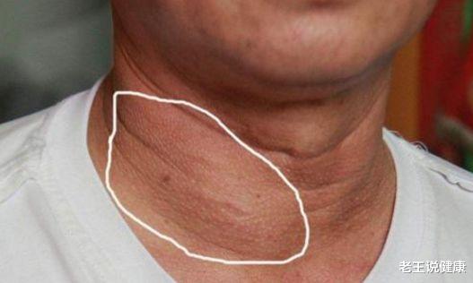 甲状腺结节@甲状腺结节的“克星”，每天坚持吃一点，活血化瘀，消肿杀菌