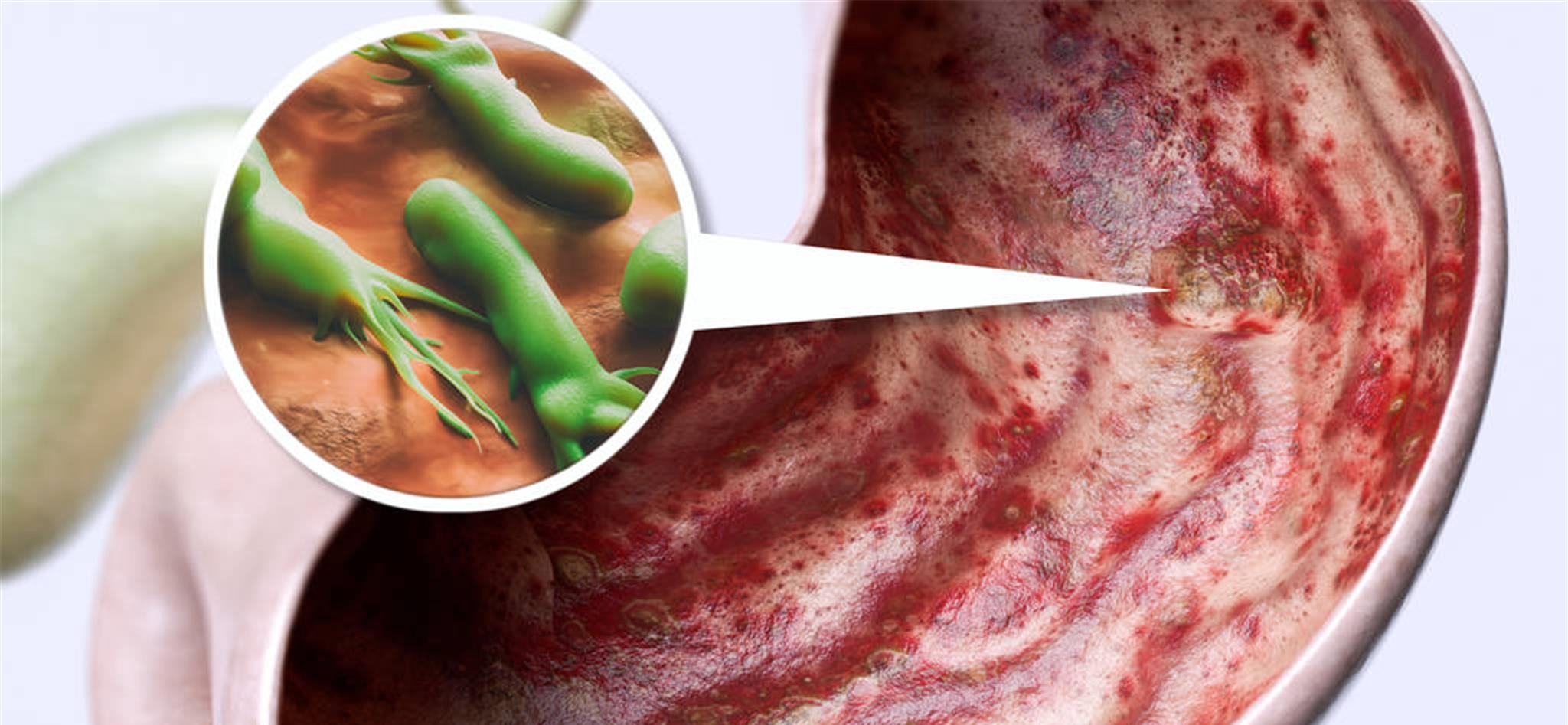 胃病|胃病的“祸根”揪出来了！2种食物几乎家家都吃，赶紧撤下餐桌