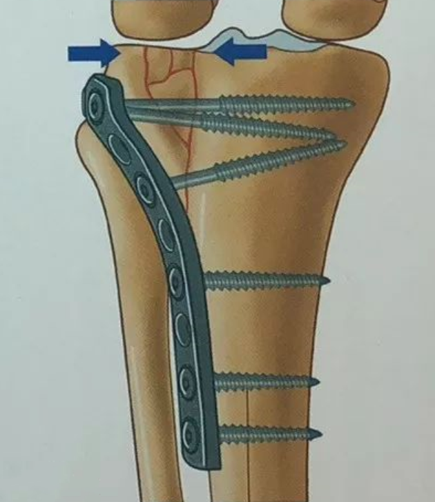 谢楠|吴京曝谢楠桡骨钢钉照!形状像耙子看着就疼,两人乐观互动显甜蜜