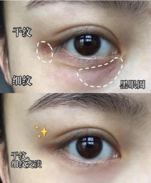 眼霜@看完戚薇“涂眼霜”，才发现自己错了多年！难怪她双眼细嫩没干纹