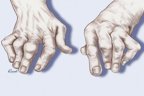 「痛风」为何\痛风\越来越多？医生提醒：这3种食物是帮凶，趁早远离