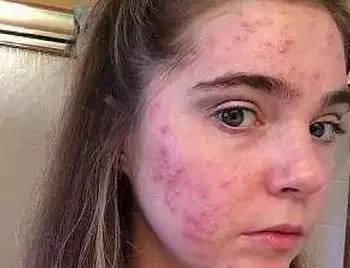 水果|最伤肝的“水果”被公布，不少人当成宝，整天往家提，应及时远离