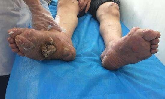 痛风▲痛风天然“降酸水”，别舍不得吃！吃越多尿酸降越低