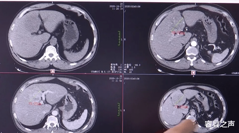 容县之声|广西五旬男子吃鱼生32年，胆管长出大量寄生虫