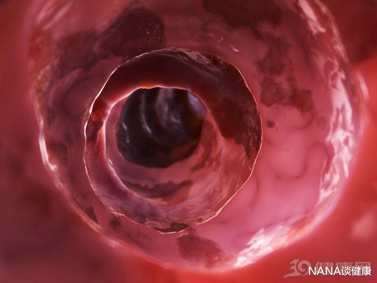 「疾病」肠镜能发现早期肠癌,好处多多,但医生说这三类人一定不能做!