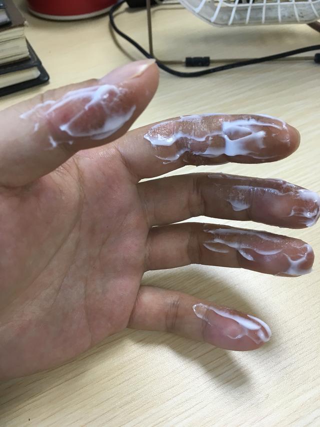 |望大V能够分享一下|真实经历分享#钓鱼人#职业病之香虎手治疗方案