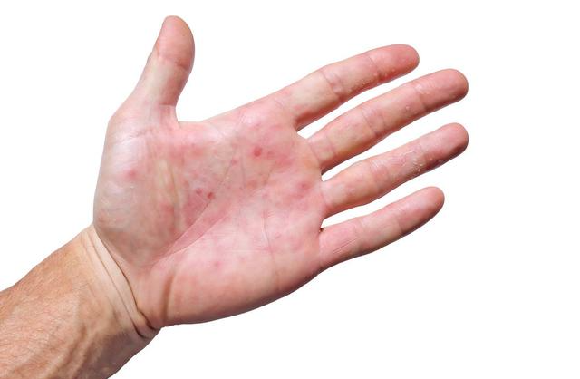 肝脏|医生提示：身体出现6个症状，十有八九是肝硬化，占一个也要CT