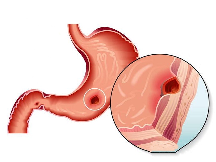 肠癌|它是慢性胃炎“天敌”，水里泡一泡，胜过消炎药，十人用十人好