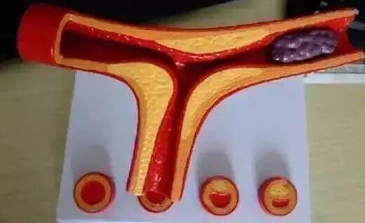 尿酸|身体有血栓时，看看手脚就知道了，经常做这2个动作，帮你疏通血管！