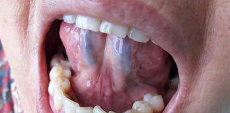 芒刺▲舌头下面的青筋为何会凸起？是身体出问题了？或是这两个问题作怪