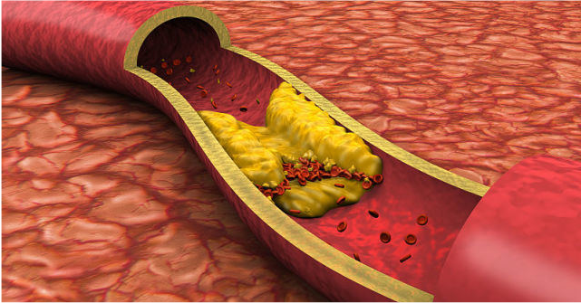 高血脂|高血脂的“根源”不只是油，这4类食物多吃一口，血管多堵一分