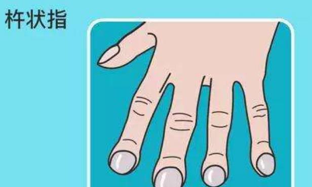 肝癌|长期吸烟的人，若出现这些“丑态”，或是肺在恳求你：快戒烟吧