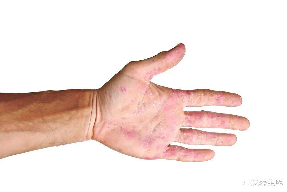 『肝脏』肝病“不痛不痒”，出现4种表现，趁早去查下肝功，小心发生癌变