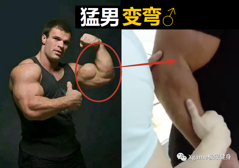 肝癌|肌肉猛男的尴尬：永久性“变弯”，掰都掰不直...